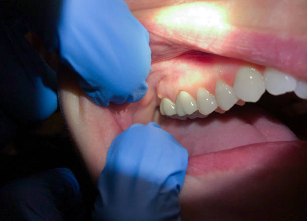 Best Dentist for Tooth Abscess  in Nuevo, CA